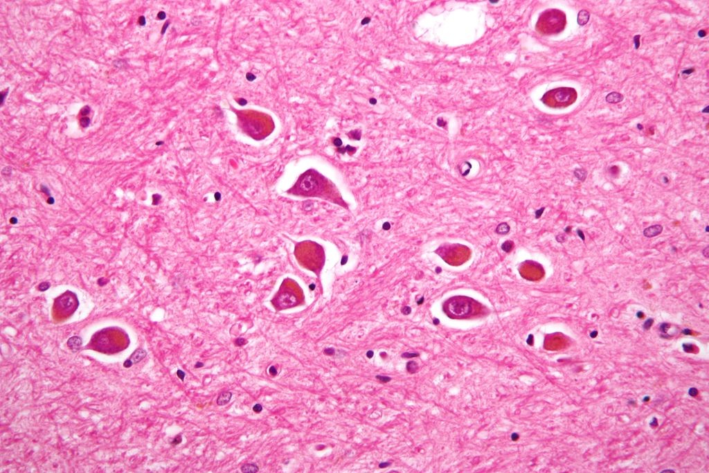 Neurônios parcialmente atrofiados por conta do Alzheimer (Foto: Wikimedia Commons)