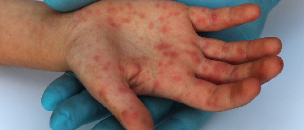 Manchas vermelhas pelo corpo são sintoma de sarampo — Foto: Febrasgo.org/Divulgação