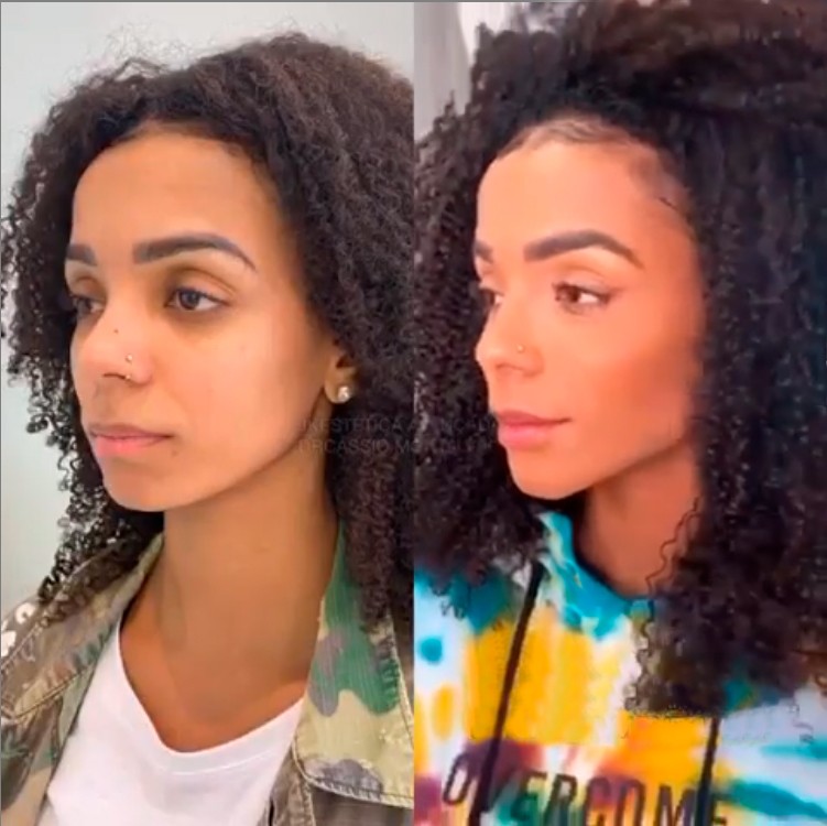 Brunna Gonçalves faz harmonização facial (Foto: Reprodução/Instagram)
