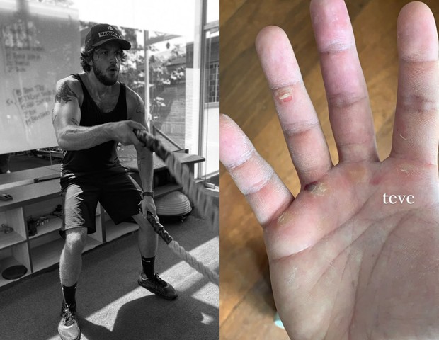 Chay mostra resultado dos calos nas mãos após treino (Foto: reprodução/Instagram)