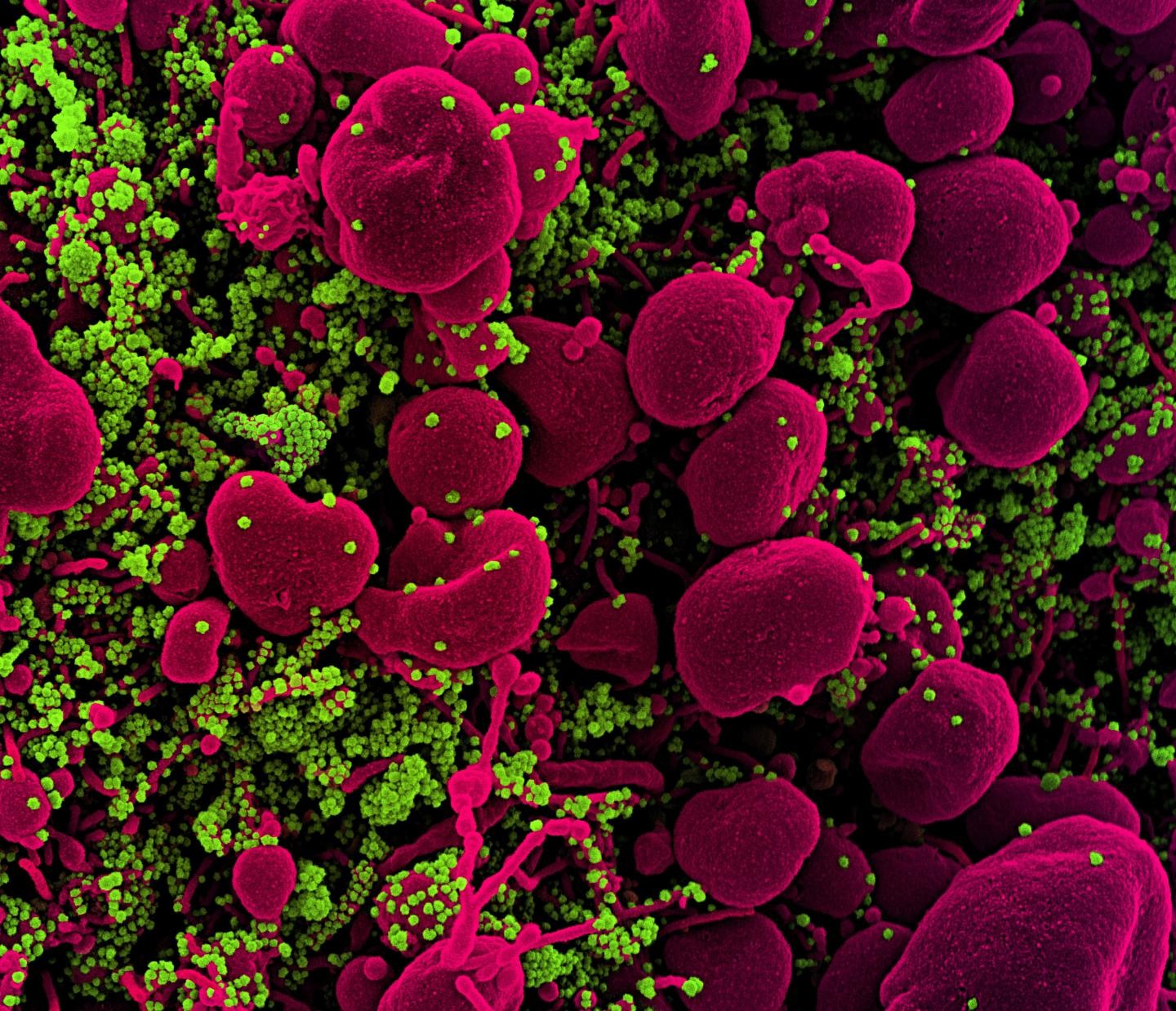 Micrografia eletrônica de varredura colorida de uma célula apoptótica (rosa) fortemente infectada com partículas do vírus SARS-COV-2 (verde), isolada de uma amostra de paciente (Foto: Instituto Nacional de Alergia e Doenças Infecciosas/NIH, 2020)