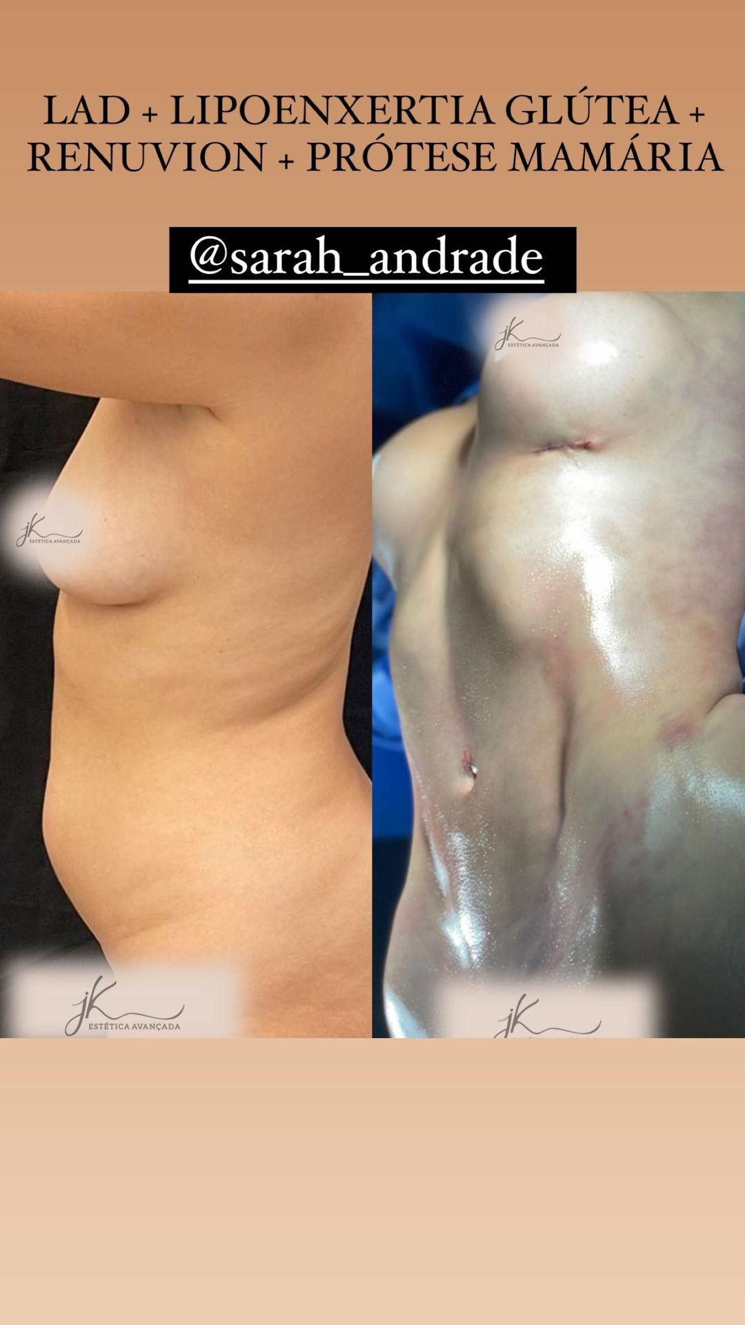 Veja o antes e depois dos procedimentos estéticos de Sarah Andrade (Foto: Reprodução/Instagram)