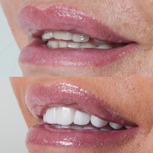 O antes e o depois de Gretchen com lentes de contatos nos dentes (Foto: Arquivo pessoal)