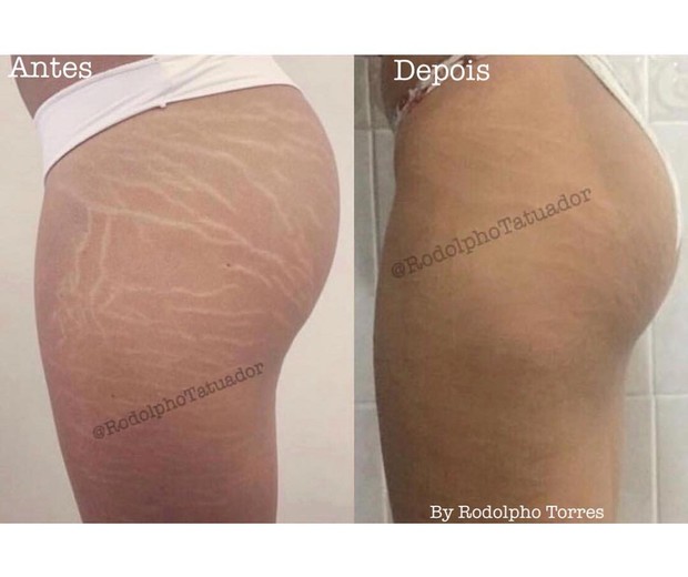 Técnica promete camuflar estrias e cicatrizes (Foto: Reprodução/Instagram)