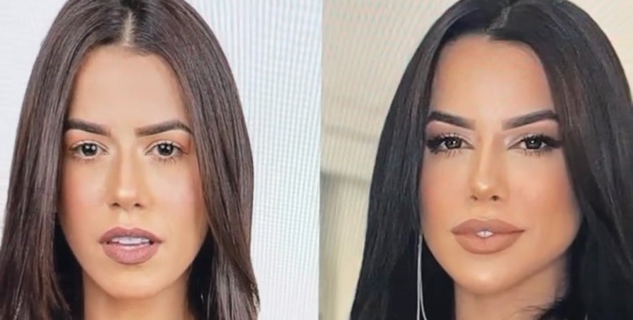Ex-BBB Larissa Tomásia antes e depois da harmonização facial