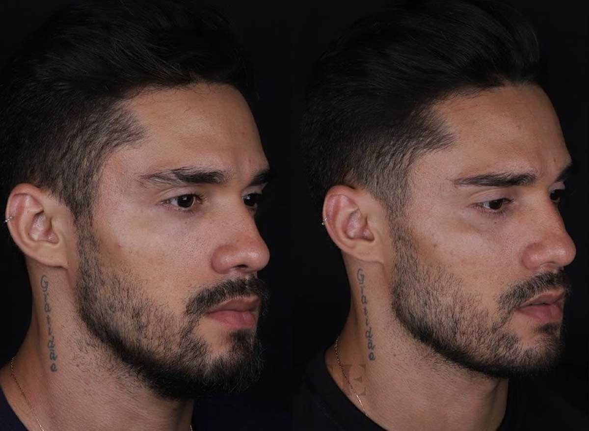 O antes e depois do procedimento de harmonização de Arcrebiano Araújo (Foto: Reprodução/Instagram)