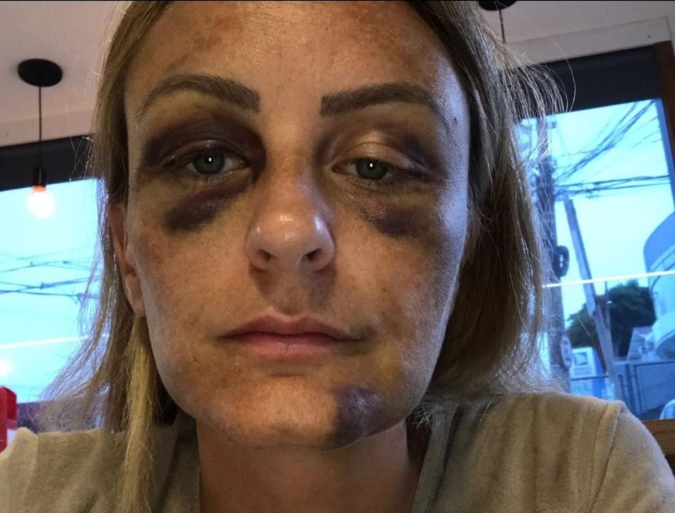Carolina Braga com ferimentos no rosto. Ela relata ter sido agredida quando namorava JP Azevedo — Foto: Reprodução/Redes sociais
