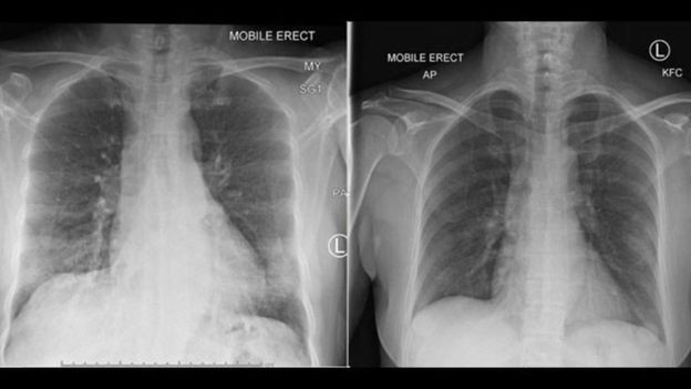 BBC: Raios-x dos pulmões de paciente mostraram a recuperação após aparecimento de células do sistema imunológico (Foto: INSTITUTO PETER DOHERTY VIA BBC)