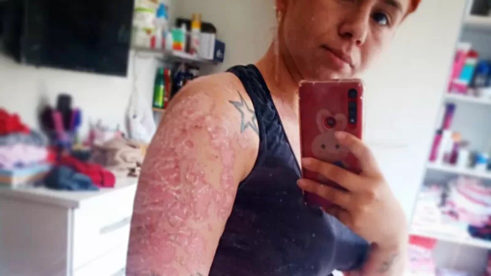 Caroline hoje tem 25 anos e está há cerca de um ano sem crises. — Foto: Arquivo pessoal via BBC