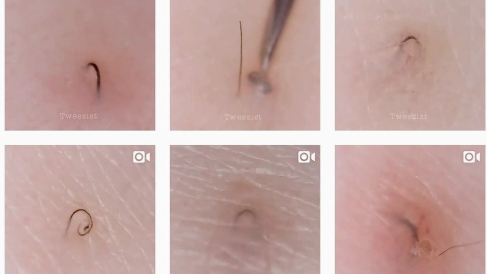 Sul Coreana Faz Sucesso No Instagram Com Videos Desencravando Pelos Tecnologia G1