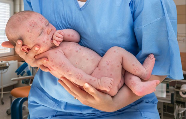 Bebê com manchas vermelhas no corpo (Foto: Thinkstock)