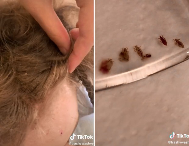 Testa da menina estava machucada por picadas dos parasitas (Foto: Reprodução/Tik Tok)