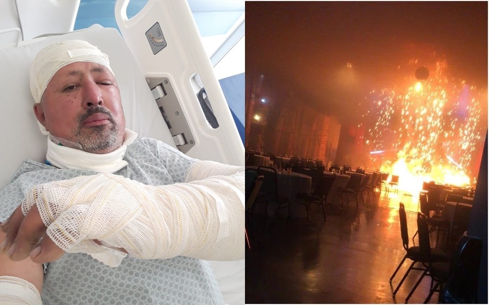 Após três cirurgias de enxerto, brigadista ferido em incêndio no Mavsa Resort recebe alta