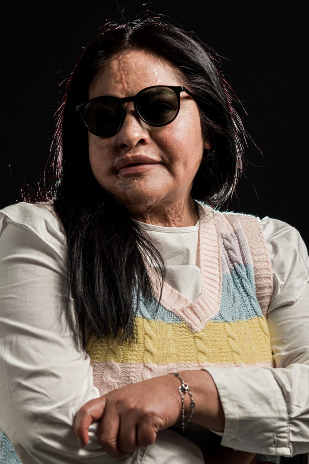 Carmen Sanchez mostra as cicatrizes ap&oacute;s ataque com &aacute;cido no M&eacute;xico &mdash; Foto: Omar Torres/AFP