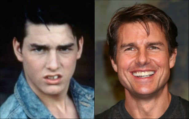 Tom Cruise continua sendo um dos maiores galãs de Hollywood, mas, após esta foto dele na juventude começar a circular pela internet, descobrimos que o ator já teve uma dentição problemática. (Foto: Tumblr e Getty Images)
