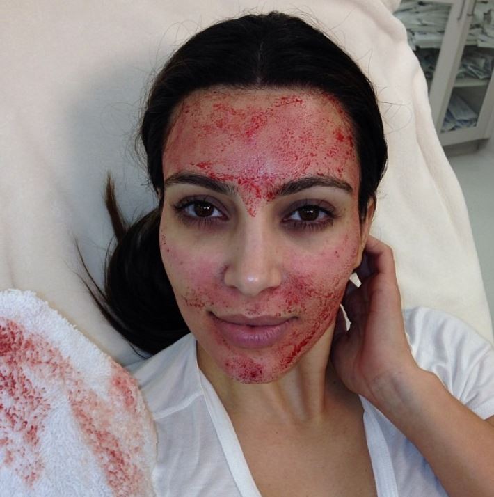 Kim Kardashian em foto publicada por ela em 2013 durante tratamento conhecido como 