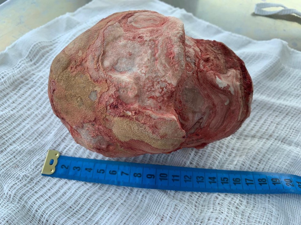 Lavrador de 51 anos teve pedra de 1,3 Kg e com 18 cm retirada da bexiga em cirurgia na Bahia â?? Foto: Renan Oliveira Barreto