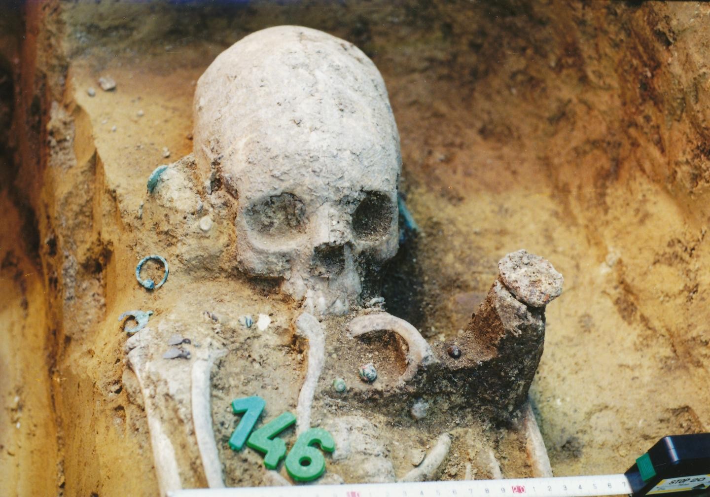Crânio artificialmente deformado de uma menina que viveu na região (Foto: Wosinsky Mór Museum, Szekszárd, Hungary.)