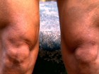 Especialistas explicam como joelhos funcionam e como evitar lesão e dor
