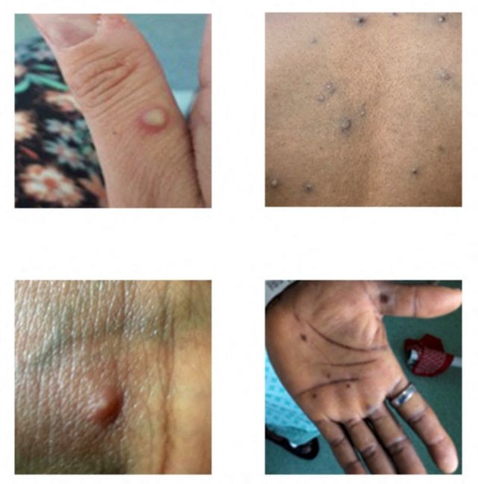 Alguns exemplos de lesões características da varíola dos macacos — Foto: Reuters via BBC