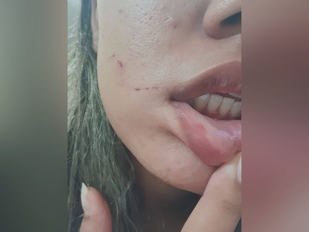 Jovem de 22 anos ficou com ferimentos no rosto e na boca após agressão ocorrida em junho de 2021. — Foto: Arquivo pessoal