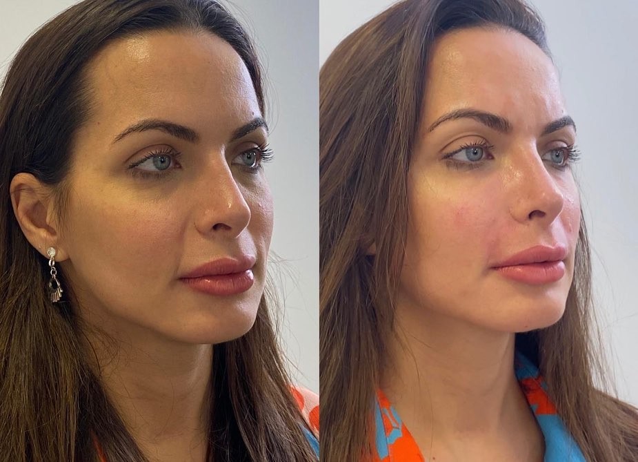 Carla Prata: antes e depois de procedimentos estéticos (Foto: Reprodução Instagram)