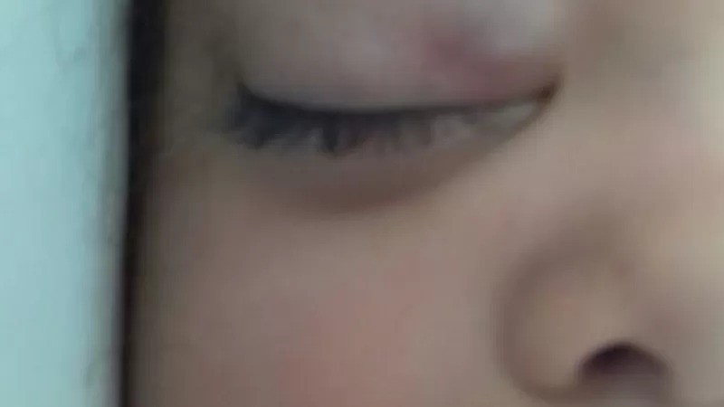 O primeiro inchaço no olho de Yasmin começou quando ela tinha dois anos (Foto: ARQUIVO PESSOAL via BBC)