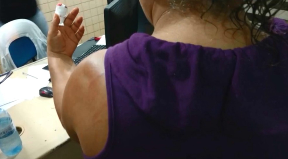 Homem morde e arranca pedaço de dedo de vizinha durante festa de ...