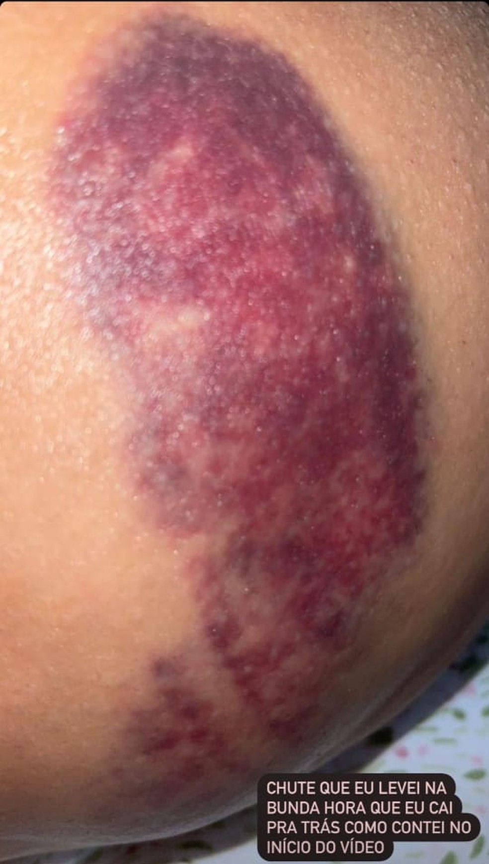 Mãe divulgou fotos dos hematomas que ela sofreu ao ser supostamente agredida pelo casal no restaurante em Cuiabá — Foto: Instagram