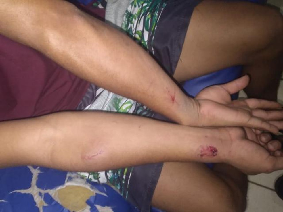 Lesões de mordida nos braços do irmão, de 21 anos, que tentou defender a mãe das agressões. — Foto: Divulgação/PMRR