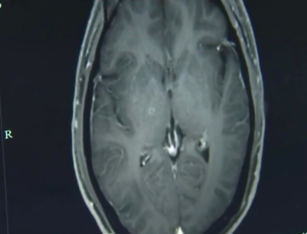 Imagem do cérebro do homem que comeu carne de porco crua e teve 700 tênias crescendo em seu cérebro (Foto: Reprodução Hospital da Universidade de Zhejiang)