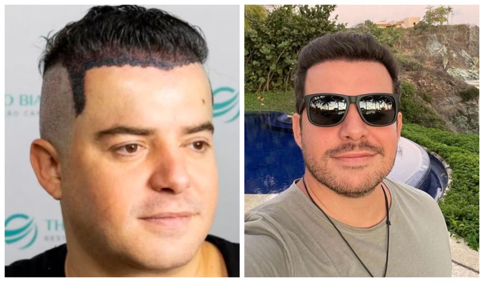 Belutti assim que fez o transplante e hoje sem entradas  — Foto: Reprodução/Instagram