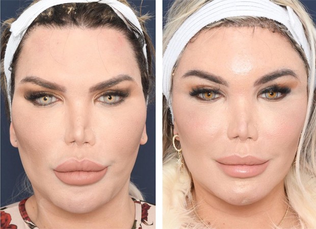Roddy Alves mostra o antes e depois de sua cirurgia de feminização facial (Foto: Arquivo pessoal)