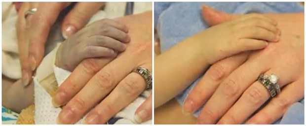 Imagens da mão do bebê um dia antes do transplante e ao lado, um dia depois (Foto: Reprodução)
