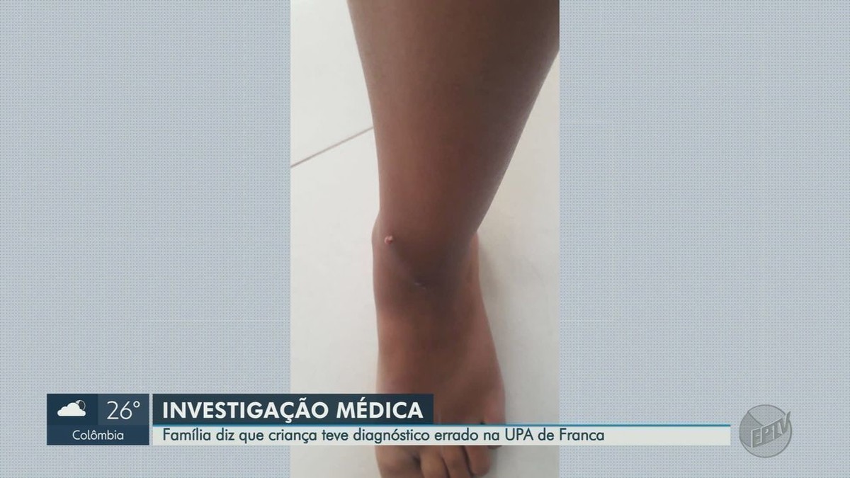 Un enfant avec un morceau de bois dans la jambe est traité à l’UPA de Franca, SP, comme s’il avait été mordu par une araignée, dit sa mère |  Ribeirao Preto et la France