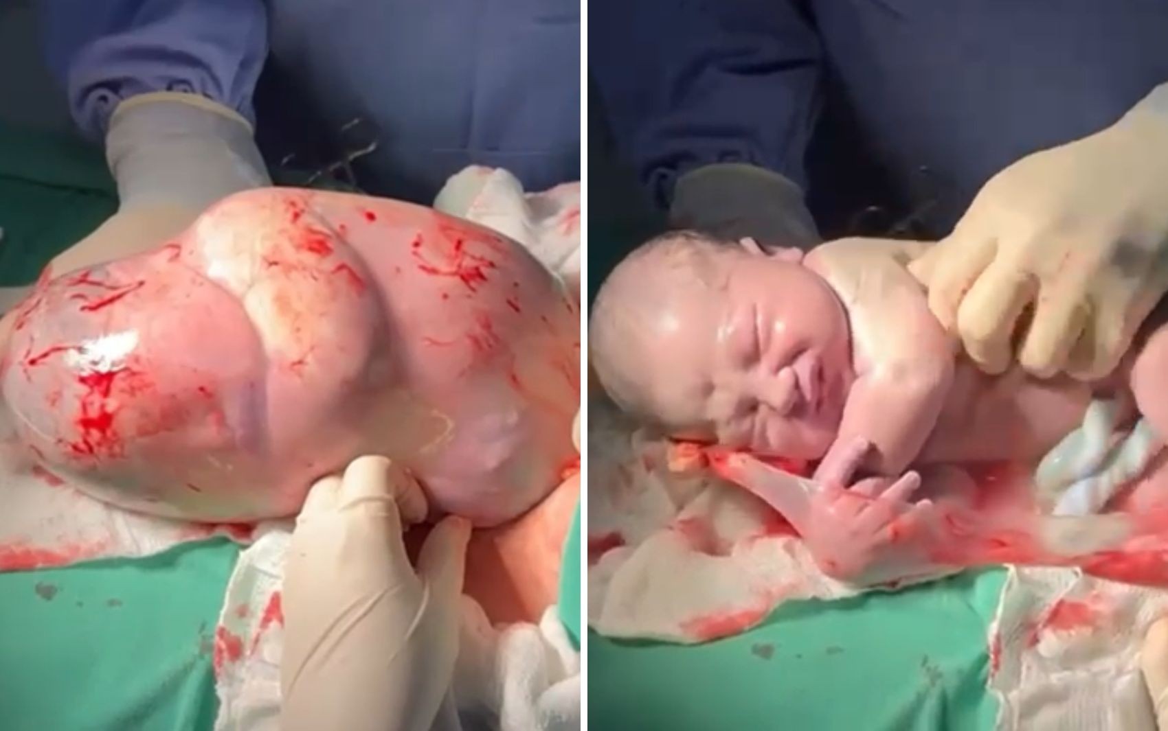 Médico fez cócegas na barriga de bebê empelicado para que ele respirasse: 'Misto de cuidado, técnica e emoção'