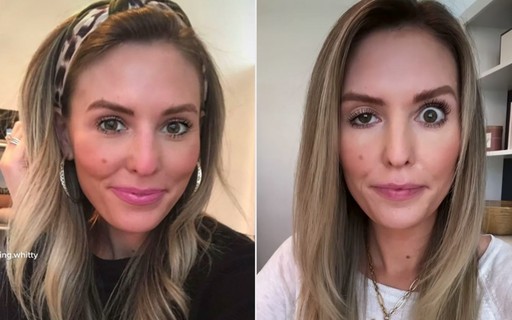 Botox: Influencer compartilha sua experiência trágica com o