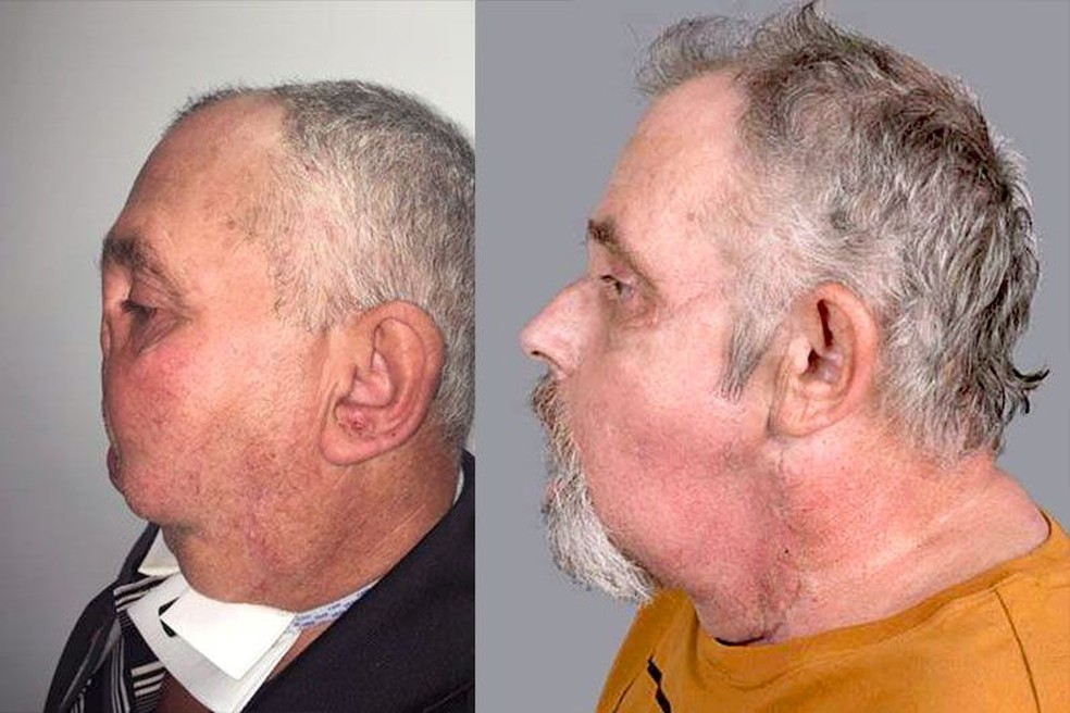 Homem passou por cirurgia de transplante de rosto após tiro acidental no Canadá — Foto: Universidade de Montreal