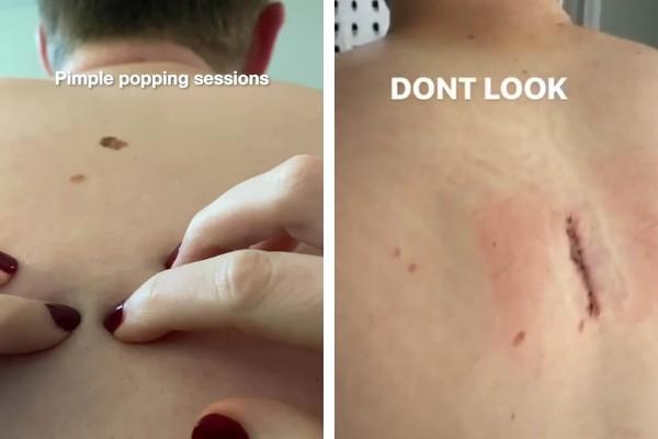 A verruga antes e depois de ser removida da pele do influencer (Foto: Reprodução/TikTok)