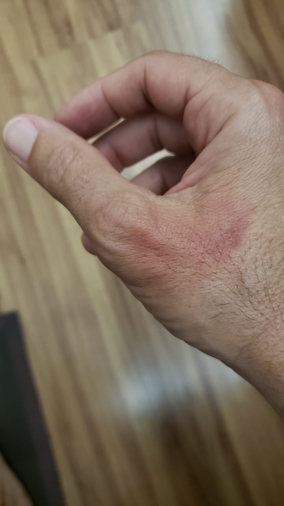 Fogo Invisivel Queima A Mao De Jornalista Que Usou Alcool Em Gel Santos E Regiao G1