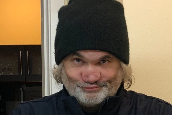 O comediante Artie Lange com nariz deformado por conta de seu consumo excessivo de drogas (Foto: Twitter)