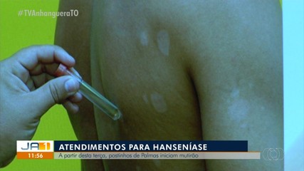 Unidades de saúde fazem teste da hanseníase em Palmas; veja programação