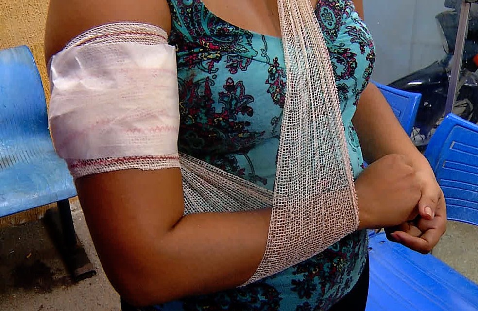 Mulher foi atingida no braÃ§o  (Foto: ReproduÃ§Ã£o/Inter TV Cabugi)