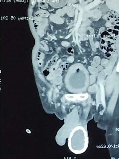 Segundo os médicos, parte externa do testículo foi calcificada como resultado de um quadro de elefantíase (Foto: BMJ Case Reports)