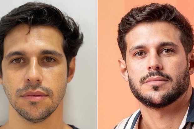 Harmoniza O Facial Em Homens Veja O Antes E Depois De Famosos Quem Quem Inspira