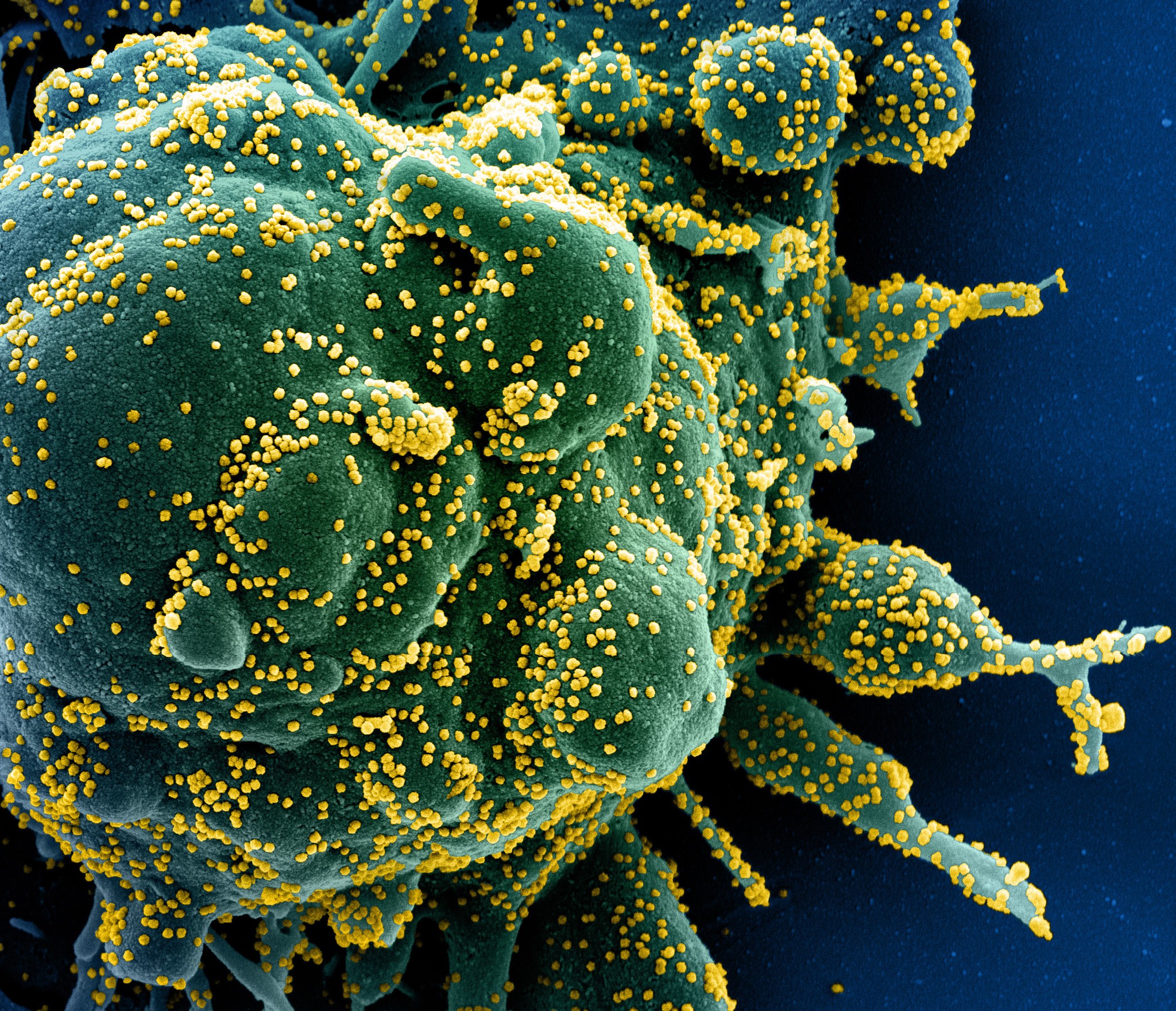 A células T podem identificar e destruir uma célula (verde) infectada pelo Sars-CoV-2 (amarelo) (Foto: NIAID)