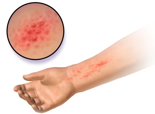 A dermatite de contato é caracterizada por uma erupção cutânea avermelhada e várias bolhas, que podem ser diminutas ou muito grandes (Foto: Wikimedia / Creative Commons)