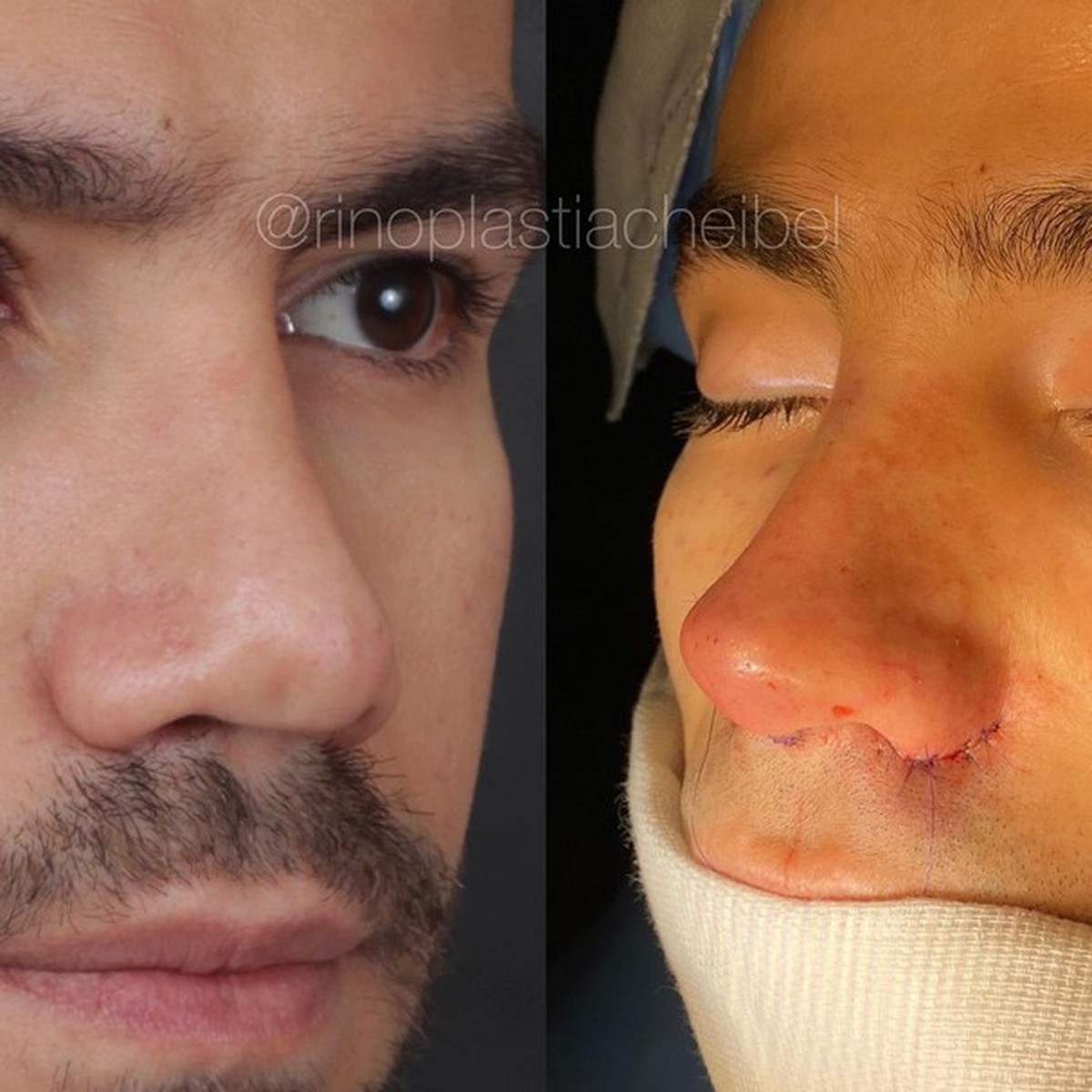 Mariano mostra o antes e depois da rinoplastia em vários fotos