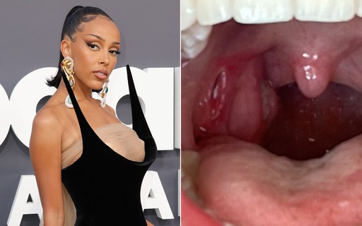 doja cat vape Doja Cat decide parar com vape após passar por cirurgia de emergência -  Quem