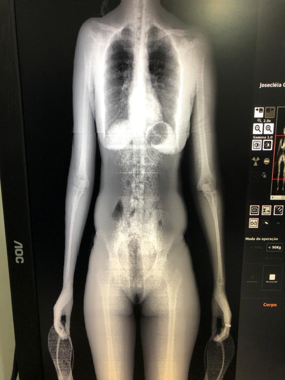 Aparelho de raio X detectou droga escondida no ânus de esposa de reeducando em Maceió — Foto: Divulgação/Sindapen